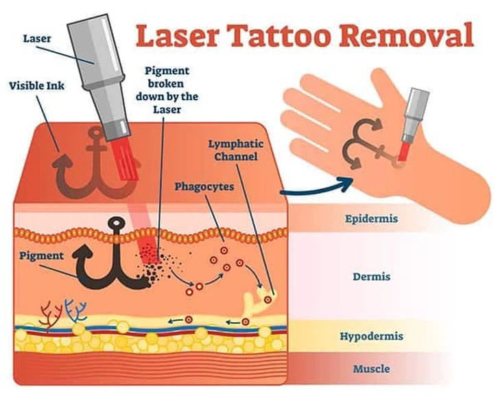 laser tattoo laser tattoo